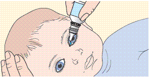 Eye drops in small child