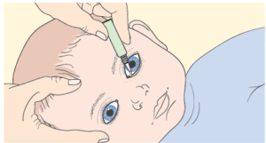 Eye ointment in small child