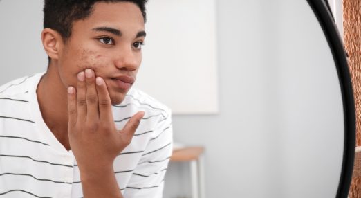 Teenage boy with acne